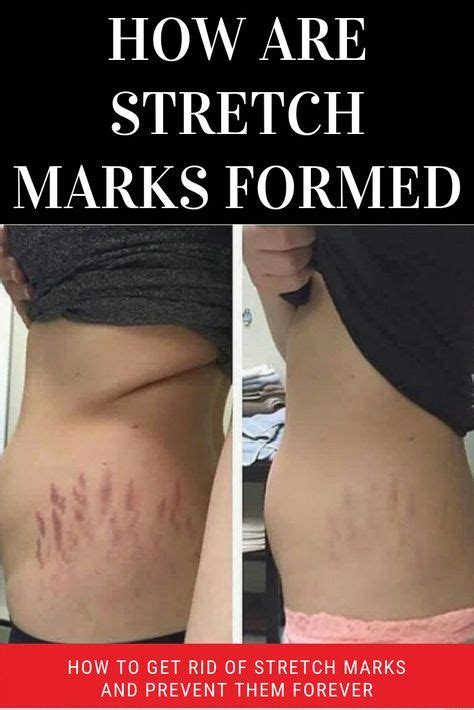 dating someone with stretch marks